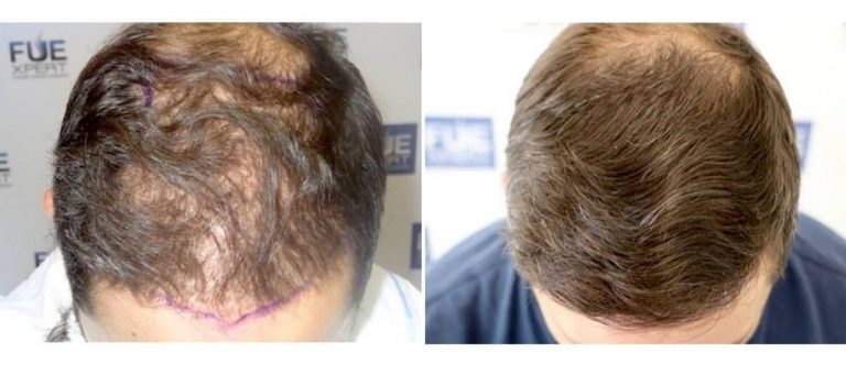 Antes y Después - 2400 Injertos- Trasplante capilar FUE - Dr Juan Couto en clínica capilar FUExpert Clinic - Madrid, España