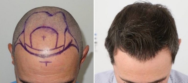 Antes y Después - 3100 Injertos- Trasplante capilar FUE - Dr Juan Couto en clínica capilar FUExpert Clinic - Madrid, España