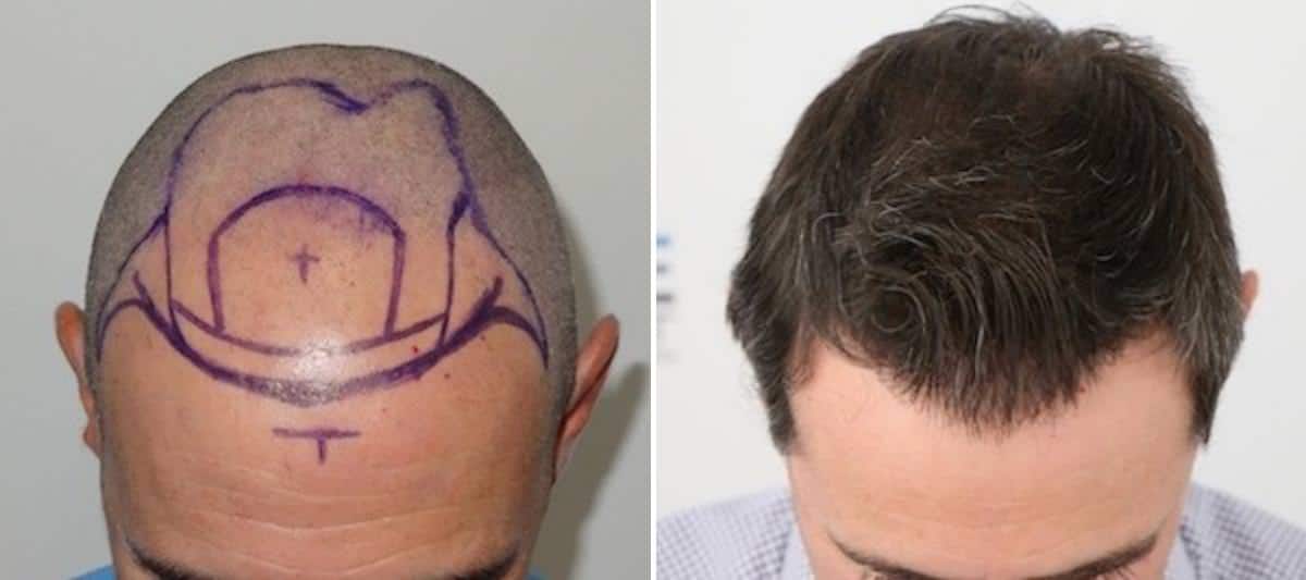 Antes y Después - 3100 Injertos- Trasplante capilar FUE - Dr Juan Couto en clínica capilar FUExpert Clinic - Madrid, España
