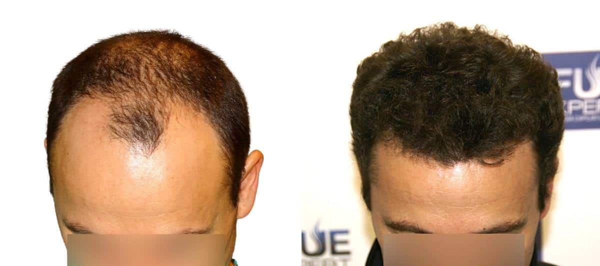 Antes y Después - 3235 Injertos- Trasplante capilar FUE - Dr Juan Couto en clínica capilar FUExpert Clinic - Madrid, España