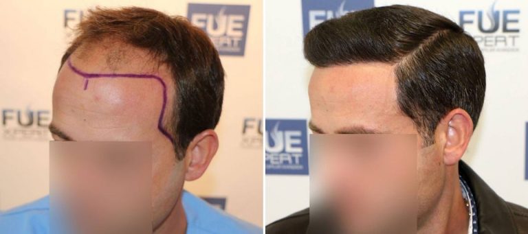 Antes y Después - 3958 Injertos- Trasplante capilar FUE - Dr Juan Couto en clínica capilar FUExpert Clinic - Madrid, España