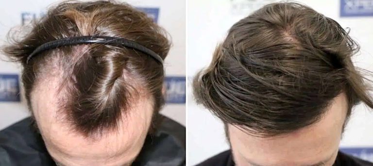 Antes-y-Después-2012-Injertos-Trasplante-capilar-FUE-Dr-Juan-Couto-en-clínica-capilar-FUExpert-Clinic-Madrid-España.jpg