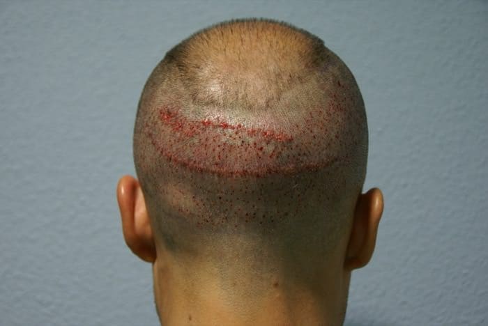640-Injertos-Reparación-capilar-FUE-cicatrices-Dr-Couto-FUExpert-Clinic-8