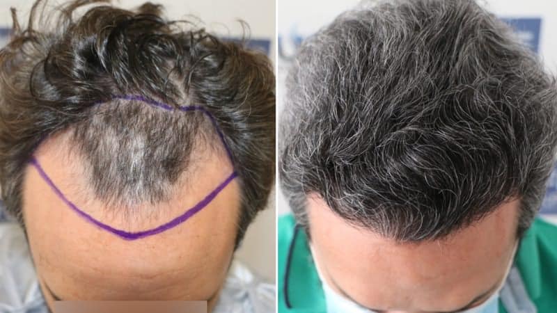 Antes - Después video Injerto Capilar FUE por el Dr Juan Couto en FUExpert Clinic, Madrid, España