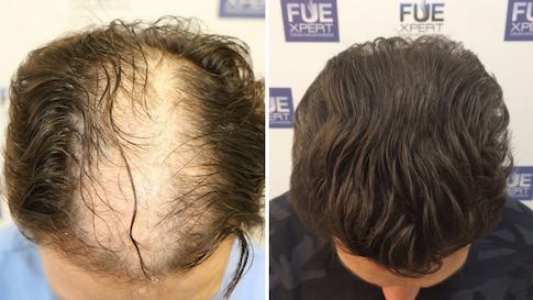 Antes y Después - 4200 Injertos - Trasplante capilar FUE - Dr Juan Couto - FUExpert Clinic - Madrid, España 485x