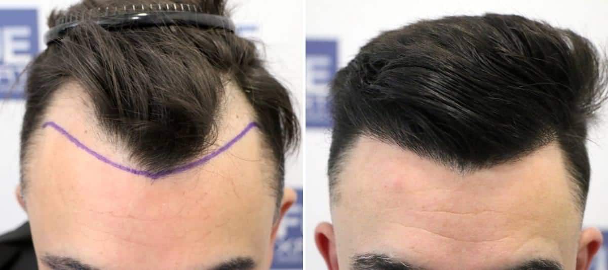 Antes y Después 1200 Injertos- Trasplante capilar FUE - Dr Juan Couto en clínica capilar FUExpert Clinic - Madrid, España