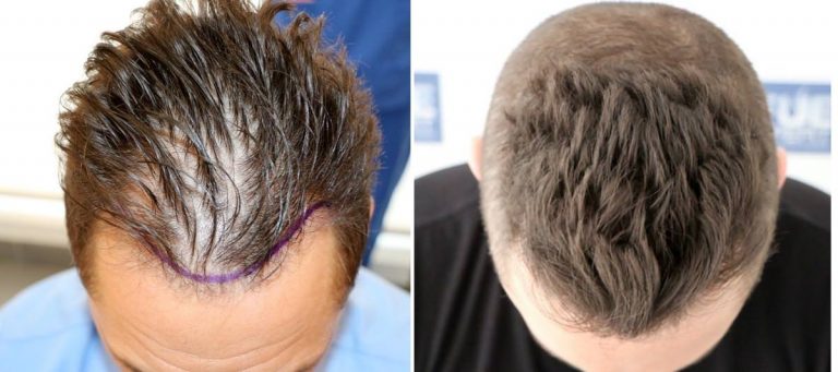 Antes y Después 1400 Injertos- Trasplante capilar FUE - Dr Juan Couto en clínica capilar FUExpert Clinic - Madrid, España