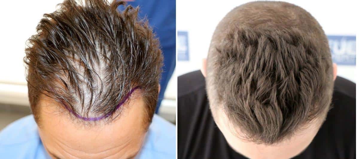 Antes y Después 1400 Injertos- Trasplante capilar FUE - Dr Juan Couto en clínica capilar FUExpert Clinic - Madrid, España