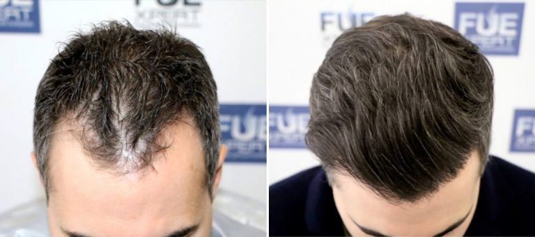 Antes y Después 1500 Injertos- Trasplante capilar FUE - Dr Juan Couto en clínica capilar FUExpert Clinic - Madrid, España