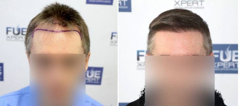 Antes y Después 1786 Injertos- Trasplante capilar FUE - Dr Juan Couto en clínica capilar FUExpert Clinic - Madrid, España