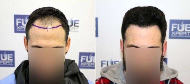 Antes y Después - 1800 Injertos- Trasplante capilar FUE - Dr Juan Couto en clínica capilar FUExpert Clinic - Madrid, España