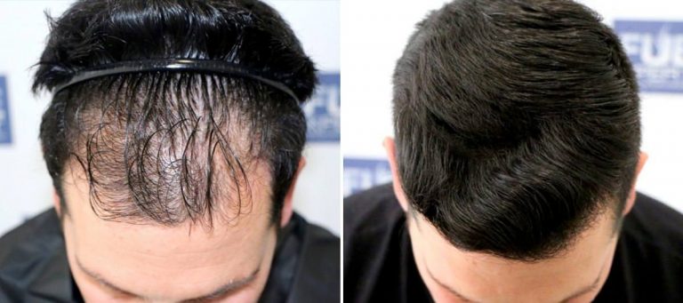 Antes y Después 2000 Injertos- Trasplante capilar FUE - Dr Juan Couto en clínica capilar FUExpert Clinic - Madrid, España