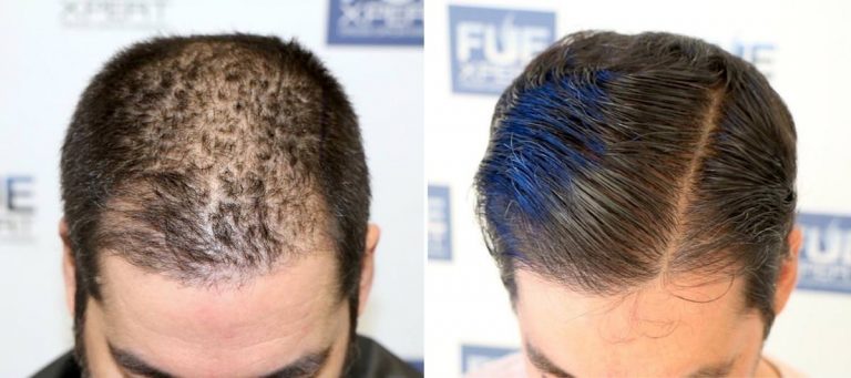 Antes y Después 2023 Injertos- Trasplante capilar FUE - Dr Juan Couto en clínica capilar FUExpert Clinic - Madrid, España