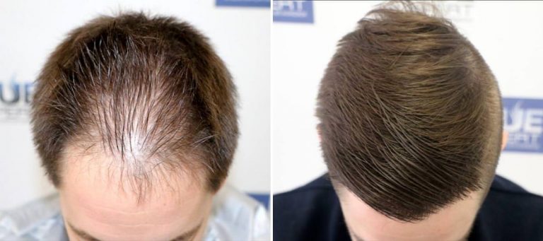 Antes y Después 2046 Injertos- Trasplante capilar FUE - Dr Juan Couto en clínica capilar FUExpert Clinic - Madrid, España