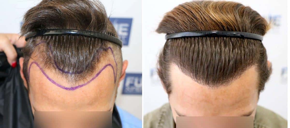 Antes y Después 2050 Injertos- Trasplante capilar FUE - Dr Juan Couto en clínica capilar FUExpert Clinic - Madrid, España