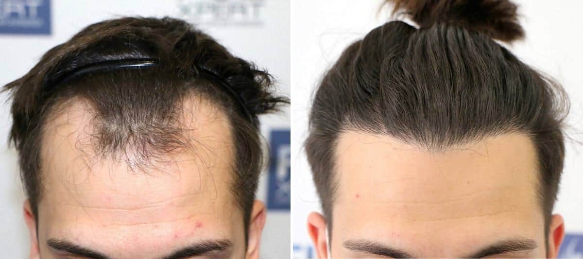 Antes y Después 2225 Injertos- Trasplante capilar FUE - Dr Juan Couto en clínica capilar FUExpert Clinic - Madrid, España