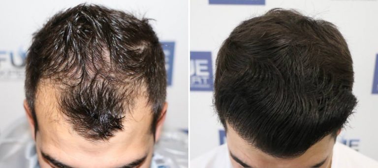 Antes y Después 2500 Injertos- Trasplante capilar FUE - Dr Juan Couto en clínica capilar FUExpert Clinic - Madrid, España