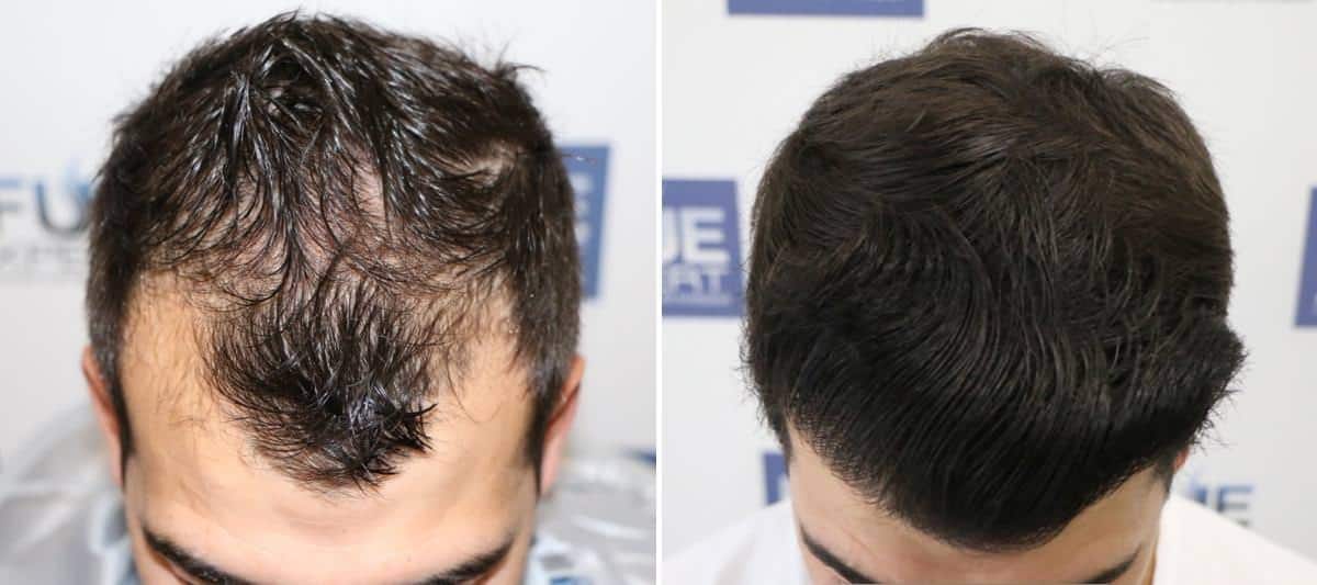 Antes y Después 2500 Injertos- Trasplante capilar FUE - Dr Juan Couto en clínica capilar FUExpert Clinic - Madrid, España