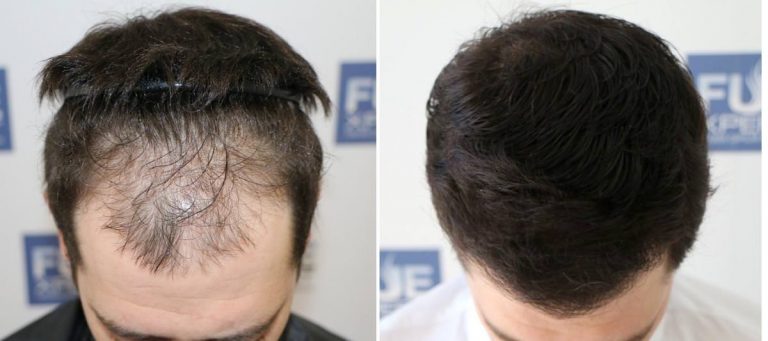 Antes y Después 2500 Injertos- Trasplante capilar FUE - Dr Juan Couto en clínica capilar FUExpert Clinic - Madrid, España