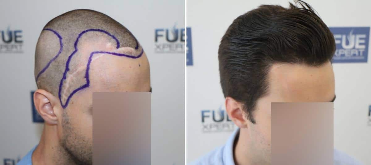 Antes y Después 2516 Injertos- Trasplante capilar FUE - Dr Juan Couto en clínica capilar FUExpert Clinic - Madrid, España