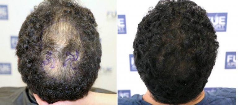 Antes y Después 2536 Injertos- Trasplante capilar FUE - Dr Juan Couto en clínica capilar FUExpert Clinic - Madrid, España