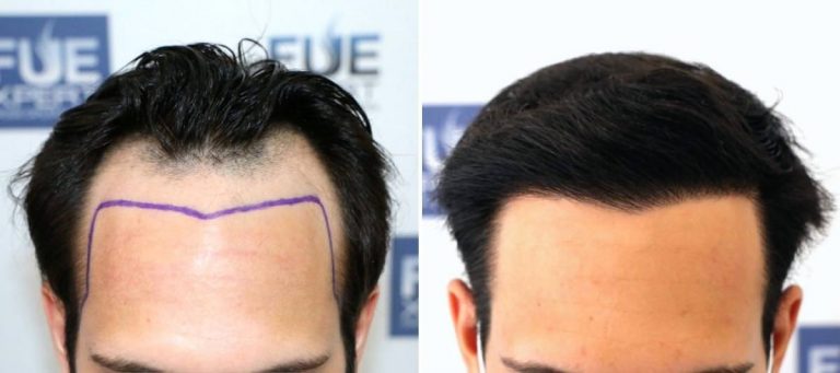 Antes y Después 2700 Injertos- Trasplante capilar FUE - Dr Juan Couto en clínica capilar FUExpert Clinic - Madrid, España
