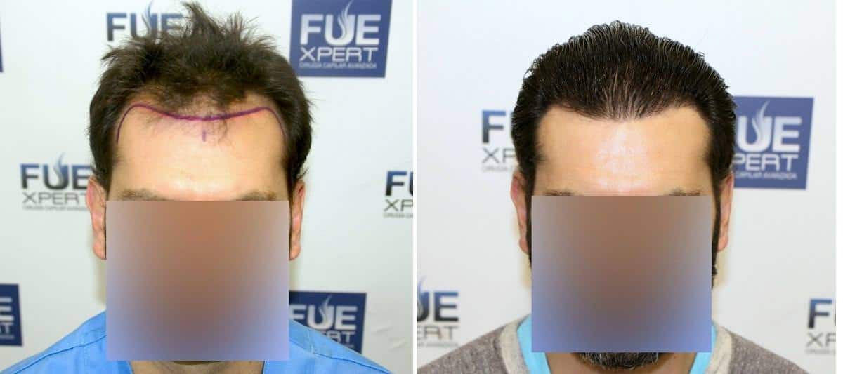 Antes y Después - 2704 Injertos- Trasplante capilar FUE - Dr Juan Couto en clínica capilar FUExpert Clinic - Madrid, España
