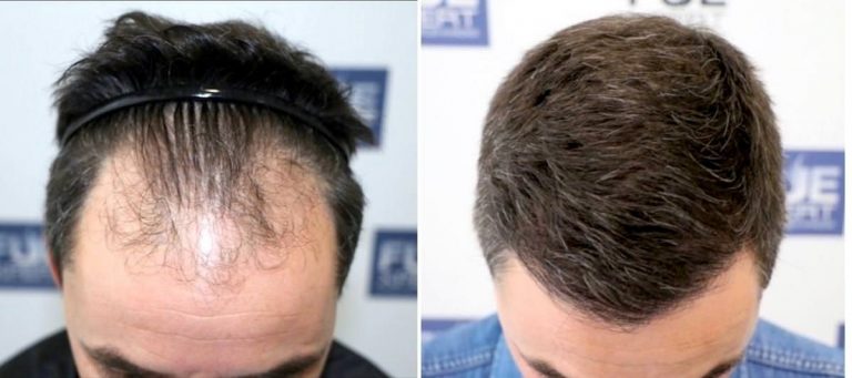 Antes y Después 2811 Injertos- Trasplante capilar FUE - Dr Juan Couto en clínica capilar FUExpert Clinic - Madrid, España