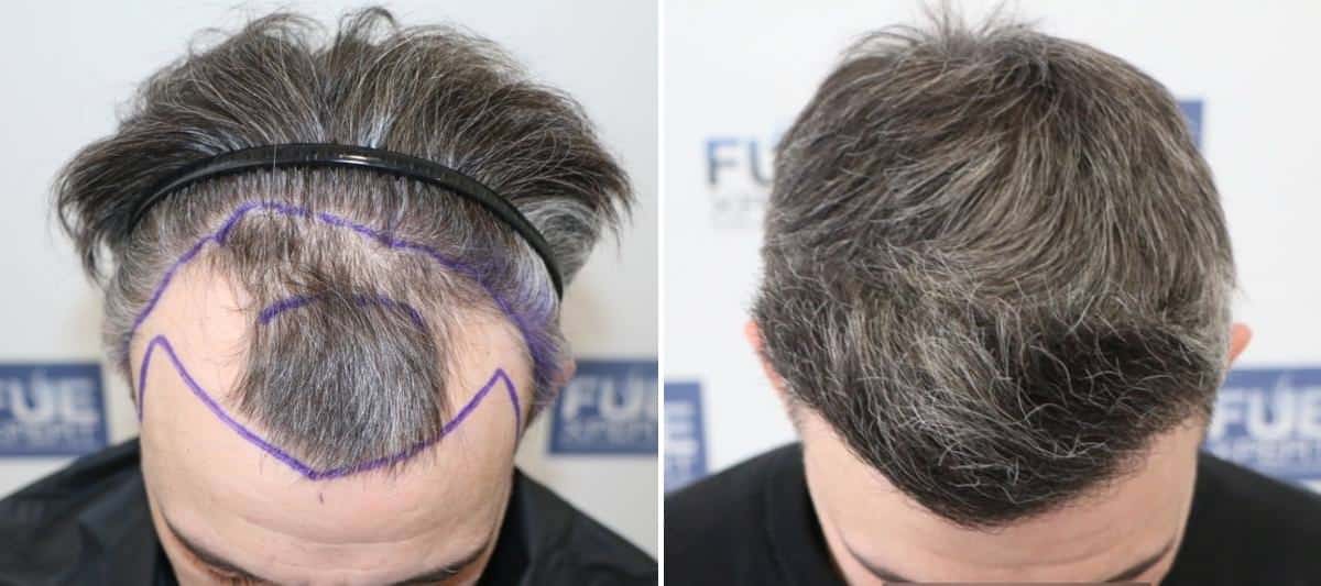 Antes y Después 2854 Injertos- Trasplante capilar FUE - Dr Juan Couto en clínica capilar FUExpert Clinic - Madrid, España