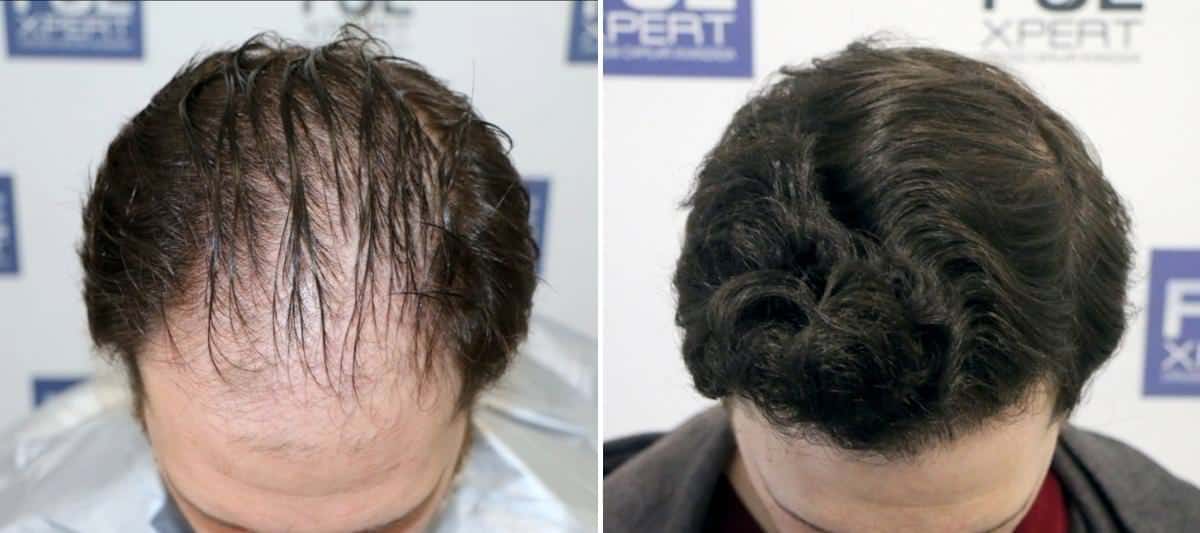Antes y Después 3057 Injertos- Trasplante capilar FUE - Dr Juan Couto en clínica capilar FUExpert Clinic - Madrid, España