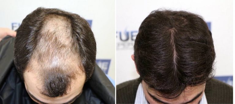 Antes y Después 3218 Injertos- Trasplante capilar FUE - Dr Juan Couto en clínica capilar FUExpert Clinic - Madrid, España