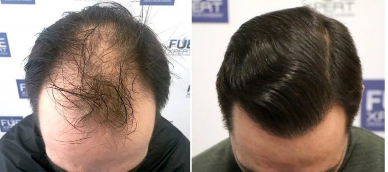 Antes y Después 3225 Injertos- Trasplante capilar FUE - Dr Juan Couto en clínica capilar FUExpert Clinic - Madrid, España