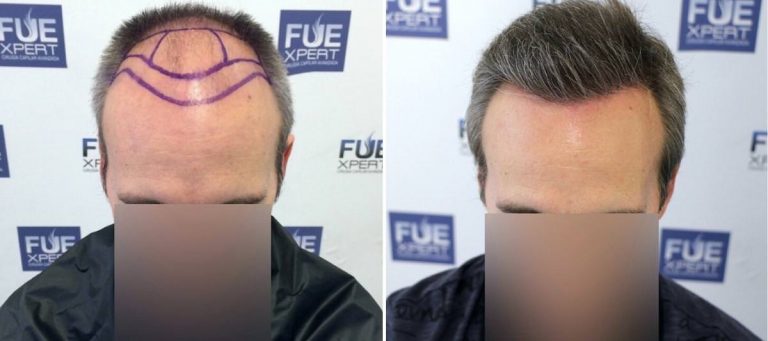 Antes y Después 3310 Injertos- Trasplante capilar FUE - Dr Juan Couto en clínica capilar FUExpert Clinic - Madrid, España