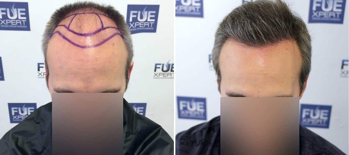 Antes y Después 3310 Injertos- Trasplante capilar FUE - Dr Juan Couto en clínica capilar FUExpert Clinic - Madrid, España