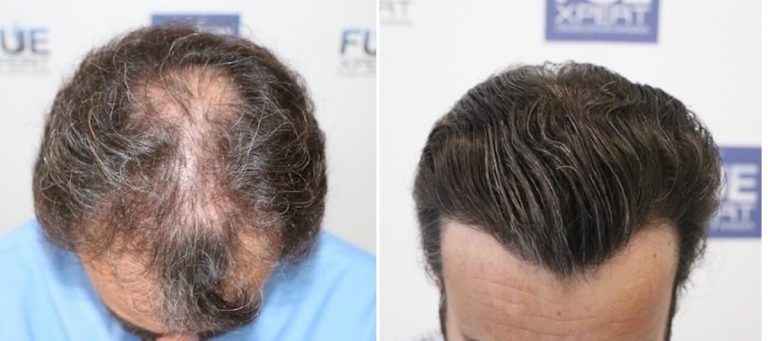 Antes y Después 3400 Injertos- Trasplante capilar FUE - Dr Juan Couto en clínica capilar FUExpert Clinic - Madrid, España