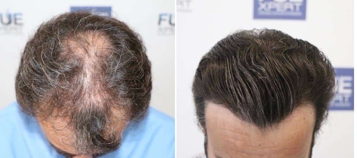 Antes y Después 3400 Injertos- Trasplante capilar FUE - Dr Juan Couto en clínica capilar FUExpert Clinic - Madrid, España