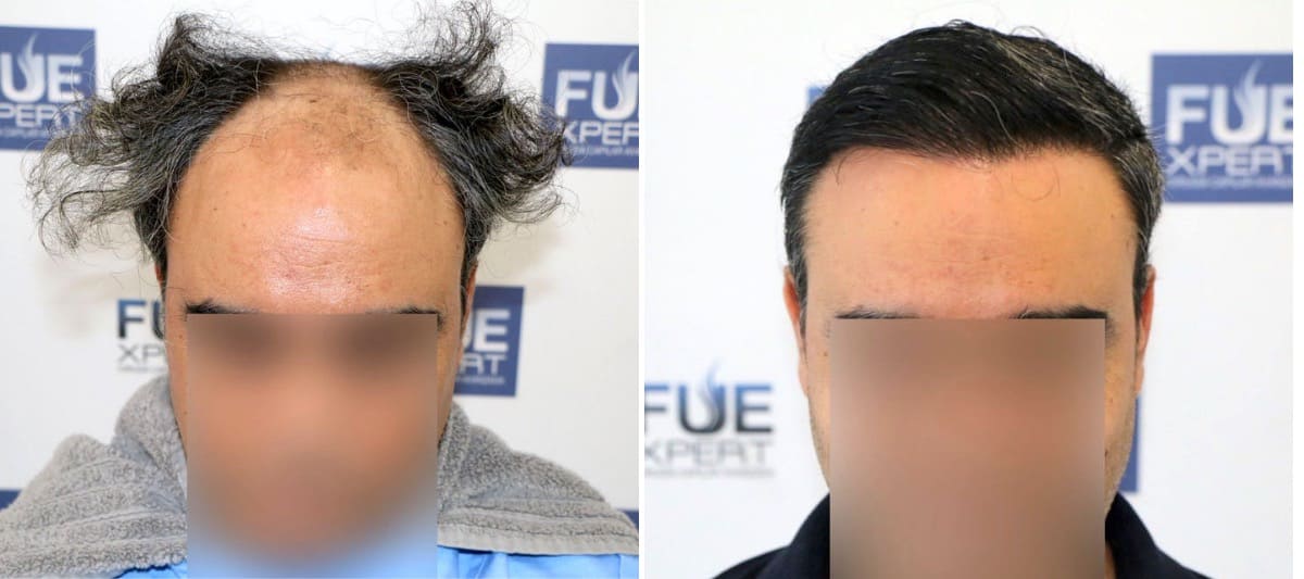 Antes y Después 3500 Injertos-  Trasplante capilar FUE - Dr Juan Couto en clínica capilar FUExpert Clinic - Madrid, España