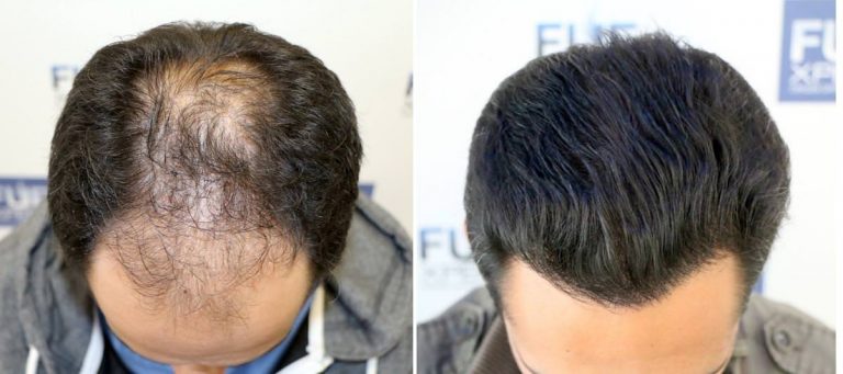 Antes y Después 3584 Injertos- Trasplante capilar FUE - Dr Juan Couto en clínica capilar FUExpert Clinic - Madrid, España
