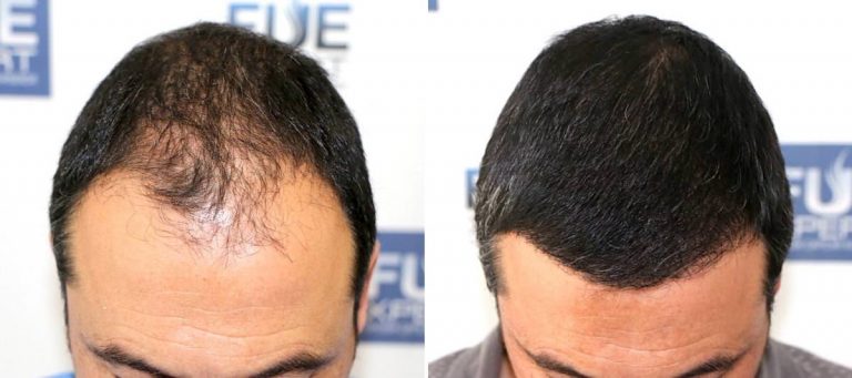 Antes y Después 3825 Injertos- Trasplante capilar FUE - Dr Juan Couto en clínica capilar FUExpert Clinic - Madrid, España