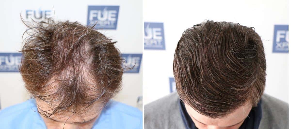 Antes y Después 4012 Injertos- Trasplante capilar FUE - Dr Juan Couto en clínica capilar FUExpert Clinic - Madrid, España