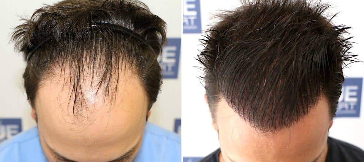 Antes y Después 4335 Injertos- Trasplante capilar FUE - Dr Juan Couto en clínica capilar FUExpert Clinic - Madrid, España