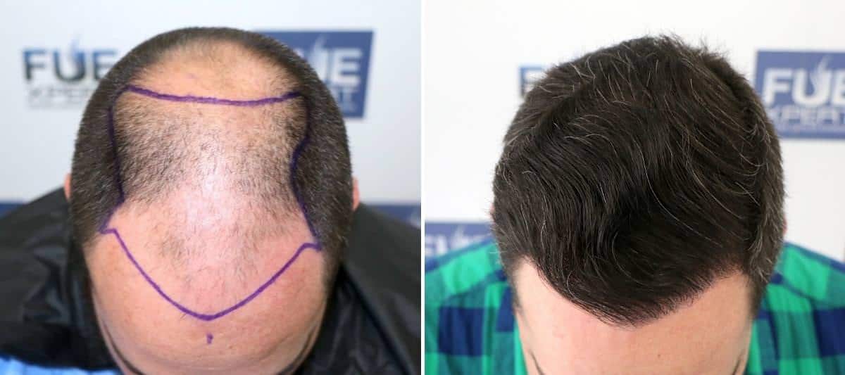 Antes y Después 4766 Injertos- Trasplante capilar FUE - Dr Juan Couto en clínica capilar FUExpert Clinic - Madrid, España