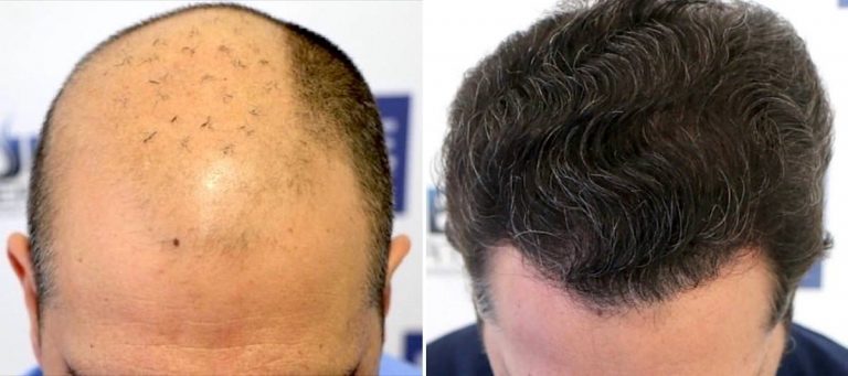 Antes y Después 5805 Injertos- Trasplante capilar FUE - Dr Juan Couto en clínica capilar FUExpert Clinic - Madrid, España