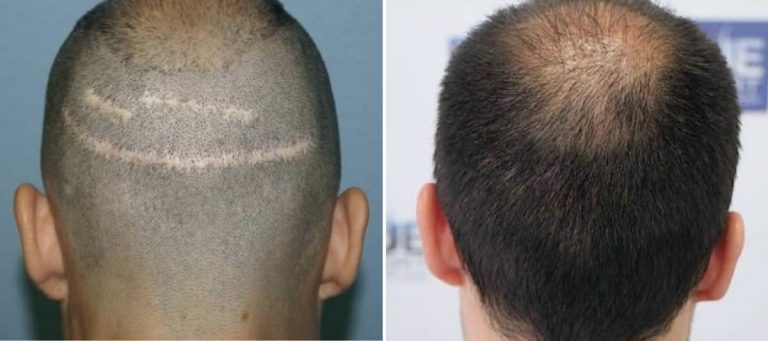 Antes y Después 640 Injertos- Trasplante capilar FUE - Dr Juan Couto en clínica capilar FUExpert Clinic - Madrid, España