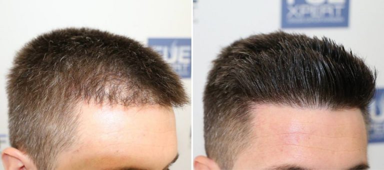 Antes y Después 705 Injertos- Trasplante capilar FUE - Dr Juan Couto en clínica capilar FUExpert Clinic - Madrid, España