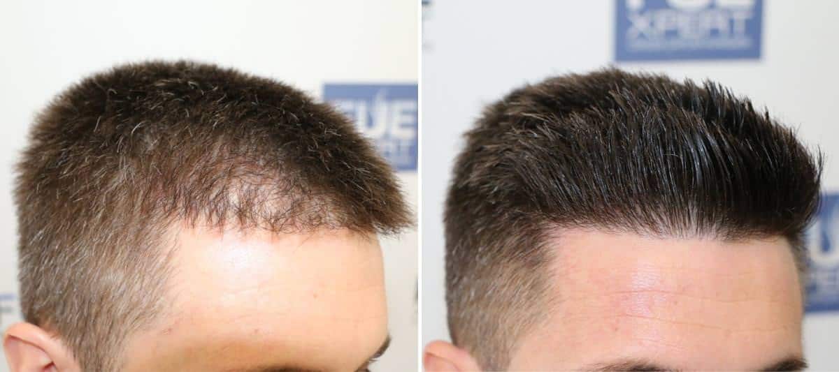 Antes y Después 705 Injertos- Trasplante capilar FUE - Dr Juan Couto en clínica capilar FUExpert Clinic - Madrid, España