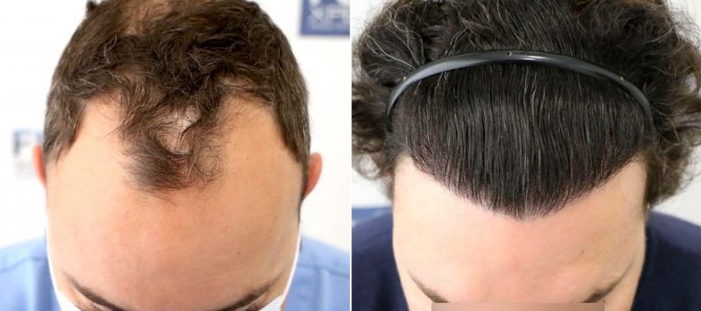 Antes y Después 2810 Injertos- Trasplante capilar FUE - Dr Juan Couto en clínica capilar FUExpert Clinic - Madrid, España 1200