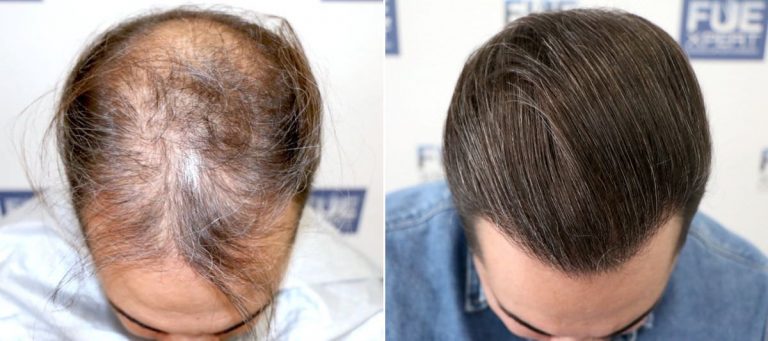 Antes y Después 3586 Injertos - Trasplante capilar FUE - Dr Juan Couto en clínica capilar FUExpert Clinic - Madrid, España 1200