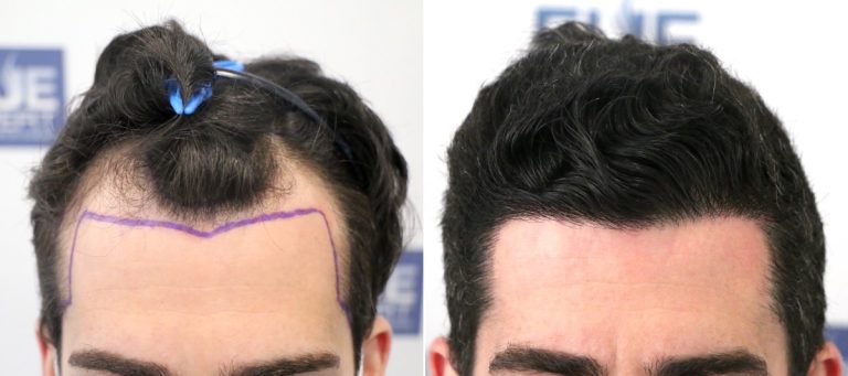 Antes después Trasplante Capilar 1800 Grafts por el Dr Juan Couto en FUExpert Clinic, Madrid, España