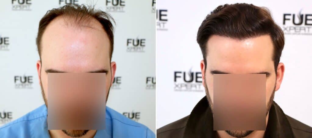 Antes-y-Despues-3100-Injertos-Trasplante-capilar-FUE-Dr-Juan-Couto-en-clinica-capilar-FUExpert-Clinic-Madrid-Espana-1-3